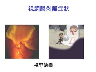 視網膜剝離症狀 視野缺損 