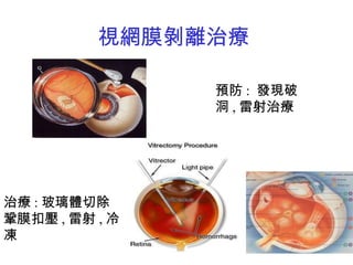 視網膜剝離治療 治療 : 玻璃體切除 鞏膜扣壓 , 雷射 , 冷凍 預防 :  發現破洞 , 雷射治療 