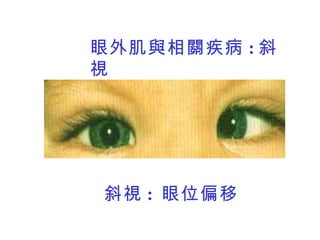 眼外肌與相關疾病 : 斜視 斜視 :  眼位偏移 