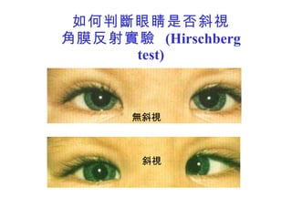 如何判斷眼睛是否斜視 角膜反射實驗  (Hirschberg test) 斜視 無斜視 