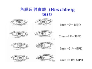 角膜反射實驗  (Hirschberg test) 1mm =7 0 = 15PD 2mm =15 0 = 30PD 3mm =21 0 = 45PD 4mm =3 0 0 = 60PD 