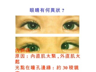 眼睛有何異狀 ? 內斜視 原因 :  內直肌太緊 , 外直肌太鬆 光點在瞳孔邊緣 :  約 30 稜鏡度 