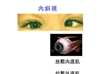 內斜視 放鬆內直肌　 拉緊外直肌 