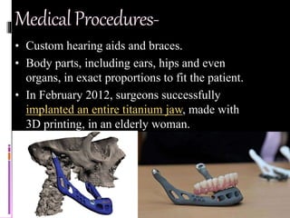 MedicalProcedures-
• Custom hearing aids and braces.
• Body parts, including ears, hips and even
organs, in exact proportions to fit the patient.
• In February 2012, surgeons successfully
implanted an entire titanium jaw, made with
3D printing, in an elderly woman.
 