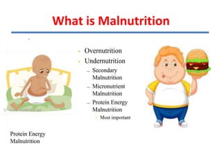 What is Malnutrition
 