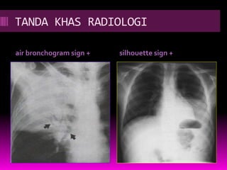 TANDA KHAS RADIOLOGI
air bronchogram sign + silhouette sign +
 