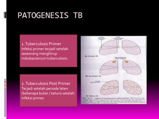 PATOGENESIS TB
1.Tuberculosis Primer
Infeksi primer terjadi setelah
seseorang menghirup
mikobacterium tuberculosis.
2.Tuberculosis Post Primer
Terjadi setelah periode laten
(beberapa bulan / tahun) setelah
infeksi primer.
 