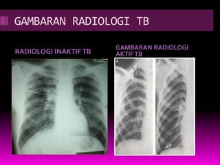 GAMBARAN RADIOLOGI TB
RADIOLOGI INAKTIFTB
GAMBARAN RADIOLOGI
AKTIFTB
 