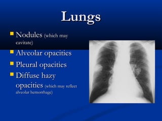 Lungs
   Nodules (which may
    cavitate)
 Alveolar opacities
 Pleural opacities
 Diffuse hazy
  opacities (which may reflect
    alveolar hemorrhage)
 