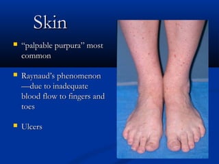 Skin
   “palpable purpura” most
    common

   Raynaud’s phenomenon
    —due to inadequate
    blood flow to fingers and
    toes

   Ulcers
 