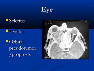 Eye
 Scleritis

 Uveitis

 Orbital
  pseudotumor
  /proptosis
 