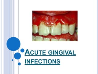 ACUTE GINGIVAL
INFECTIONS
 