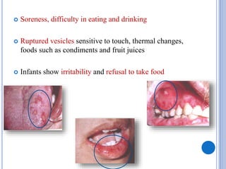  Soreness, difficulty in eating and drinking
 Ruptured vesicles sensitive to touch, thermal changes,
foods such as condiments and fruit juices
 Infants show irritability and refusal to take food
 