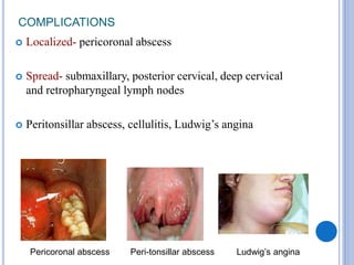 COMPLICATIONS
 Localized- pericoronal abscess
 Spread- submaxillary, posterior cervical, deep cervical
and retropharyngeal lymph nodes
 Peritonsillar abscess, cellulitis, Ludwig’s angina
Pericoronal abscess Peri-tonsillar abscess Ludwig’s angina
 