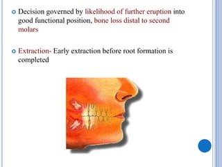  Decision governed by likelihood of further eruption into
good functional position, bone loss distal to second
molars
 Extraction- Early extraction before root formation is
completed
 