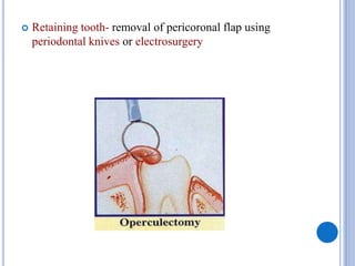  Retaining tooth- removal of pericoronal flap using
periodontal knives or electrosurgery
 