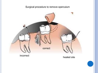 incorrect
correct
healed site
Surgical procedure to remove operculum
 