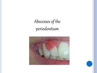 Abscesses of the
periodontium
 