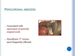 PERICORONAL ABSCESS
o Associated with
operculum of partially
erupted tooth
o Mandibular 3rd molars
most frequently affected
 