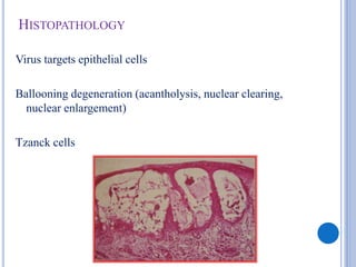HISTOPATHOLOGY
Virus targets epithelial cells
Ballooning degeneration (acantholysis, nuclear clearing,
nuclear enlargement)
Tzanck cells
 