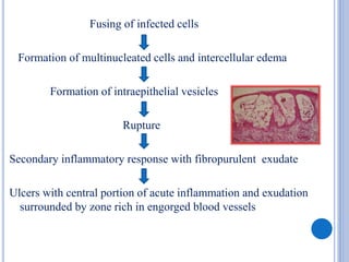 Fusing of infected cells
Formation of multinucleated cells and intercellular edema
Formation of intraepithelial vesicles
Rupture
Secondary inflammatory response with fibropurulent exudate
Ulcers with central portion of acute inflammation and exudation
surrounded by zone rich in engorged blood vessels
 