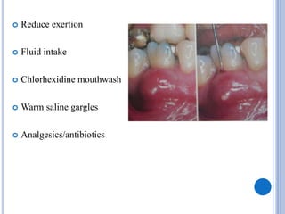  Reduce exertion
 Fluid intake
 Chlorhexidine mouthwash
 Warm saline gargles
 Analgesics/antibiotics
 