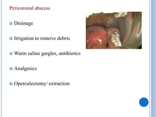 Pericoronal abscess
 Drainage
 Irrigation to remove debris
 Warm saline gargles, antibiotics
 Analgesics
 Operculectomy/ extraction
 