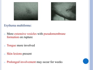 Erythema multiforme:
o More extensive vesicles with pseudomembrane
formation on rupture
o Tongue more involved
o Skin lesions present
o Prolonged involvement may occur for weeks
 