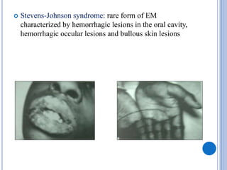  Stevens-Johnson syndrome: rare form of EM
characterized by hemorrhagic lesions in the oral cavity,
hemorrhagic occular lesions and bullous skin lesions
 