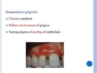 Desquamative gingivitis
 Chronic condition
 Diffuse involvement of gingiva
 Varying degree of peeling of epithelium
 