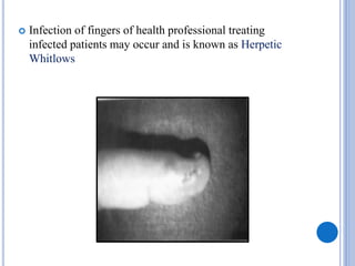  Infection of fingers of health professional treating
infected patients may occur and is known as Herpetic
Whitlows
 