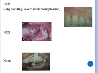 NUP
(long standing, severe immunosuppression)
NUS
Noma
 