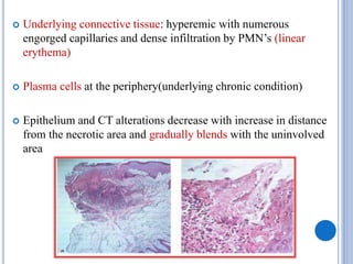  Underlying connective tissue: hyperemic with numerous
engorged capillaries and dense infiltration by PMN’s (linear
erythema)
 Plasma cells at the periphery(underlying chronic condition)
 Epithelium and CT alterations decrease with increase in distance
from the necrotic area and gradually blends with the uninvolved
area
 