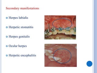 Secondary manifestations
 Herpes labialis
 Herpetic stomatitis
 Herpes genitalis
 Ocular herpes
 Herpetic encephalitis
 