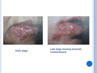 Early stage
Late stage showing brownish
crusted lesions
 