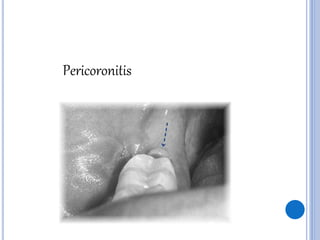 Pericoronitis
 