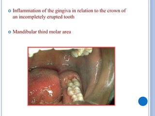  Inflammation of the gingiva in relation to the crown of
an incompletely erupted tooth
 Mandibular third molar area
 