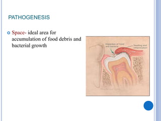 PATHOGENESIS
 Space- ideal area for
accumulation of food debris and
bacterial growth
 
