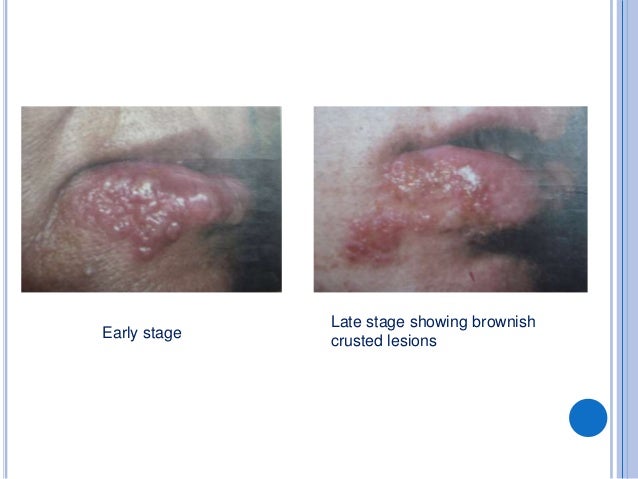 Herpes genitalis partnersuche