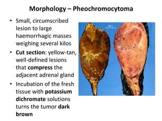 Morphology – Pheochromocytoma
• Small, circumscribed
lesion to large
haemorrhagic masses
weighing several kilos
• Cut section: yellow-tan,
well-defined lesions
that compress the
adjacent adrenal gland
• Incubation of the fresh
tissue with potassium
dichromate solutions
turns the tumor dark
brown
 