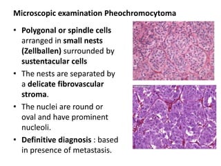 Microscopic examination Pheochromocytoma
• Polygonal or spindle cells
arranged in small nests
(Zellballen) surrounded by
sustentacular cells
• The nests are separated by
a delicate fibrovascular
stroma.
• The nuclei are round or
oval and have prominent
nucleoli.
• Definitive diagnosis : based
in presence of metastasis.
 