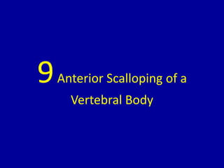 9Anterior Scalloping of a
Vertebral Body
 
