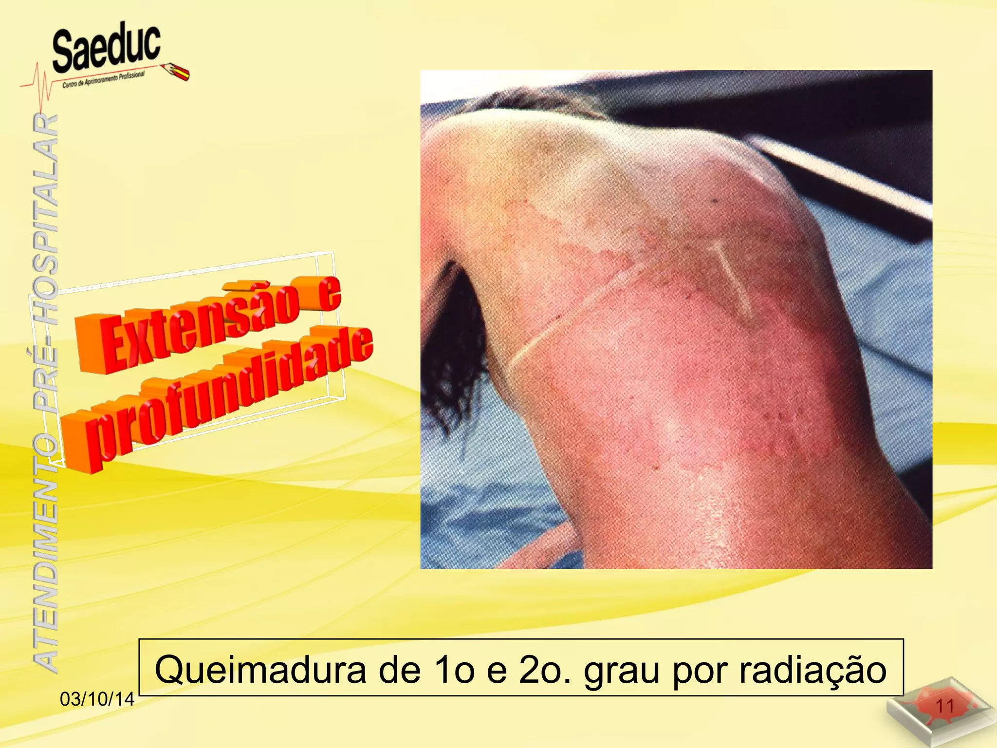 Queimadura de 1o e 2o. grau por radiação
03/10/14 11
 