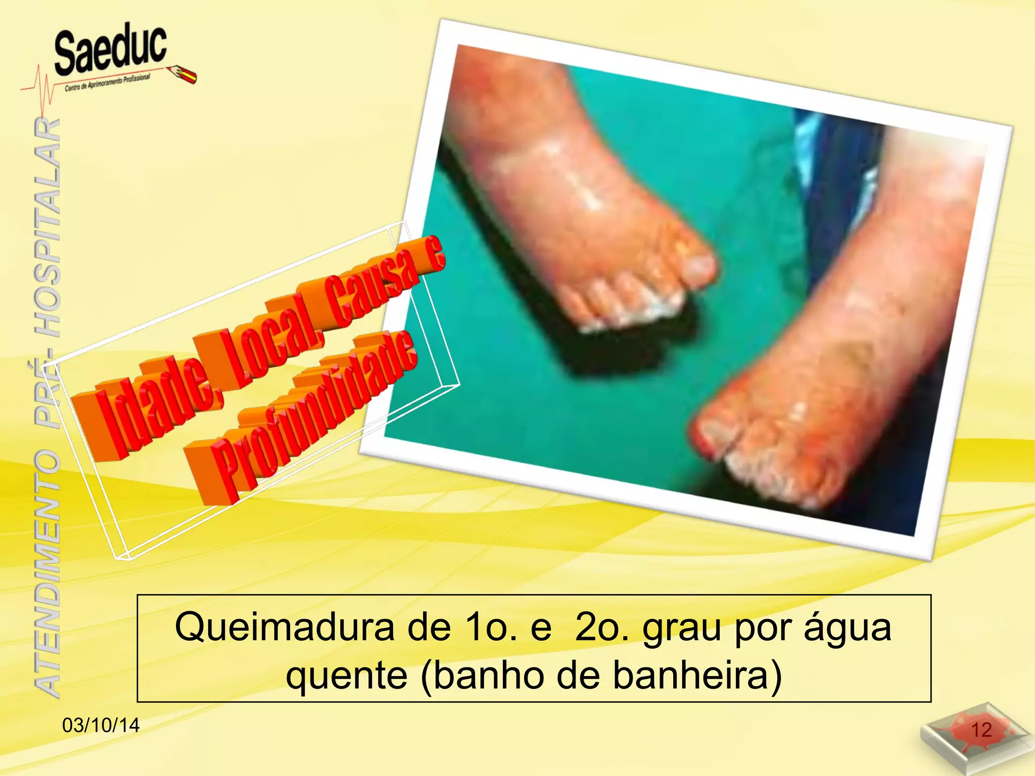 Queimadura de 1o. e 2o. grau por água
quente (banho de banheira)
03/10/14 12
 