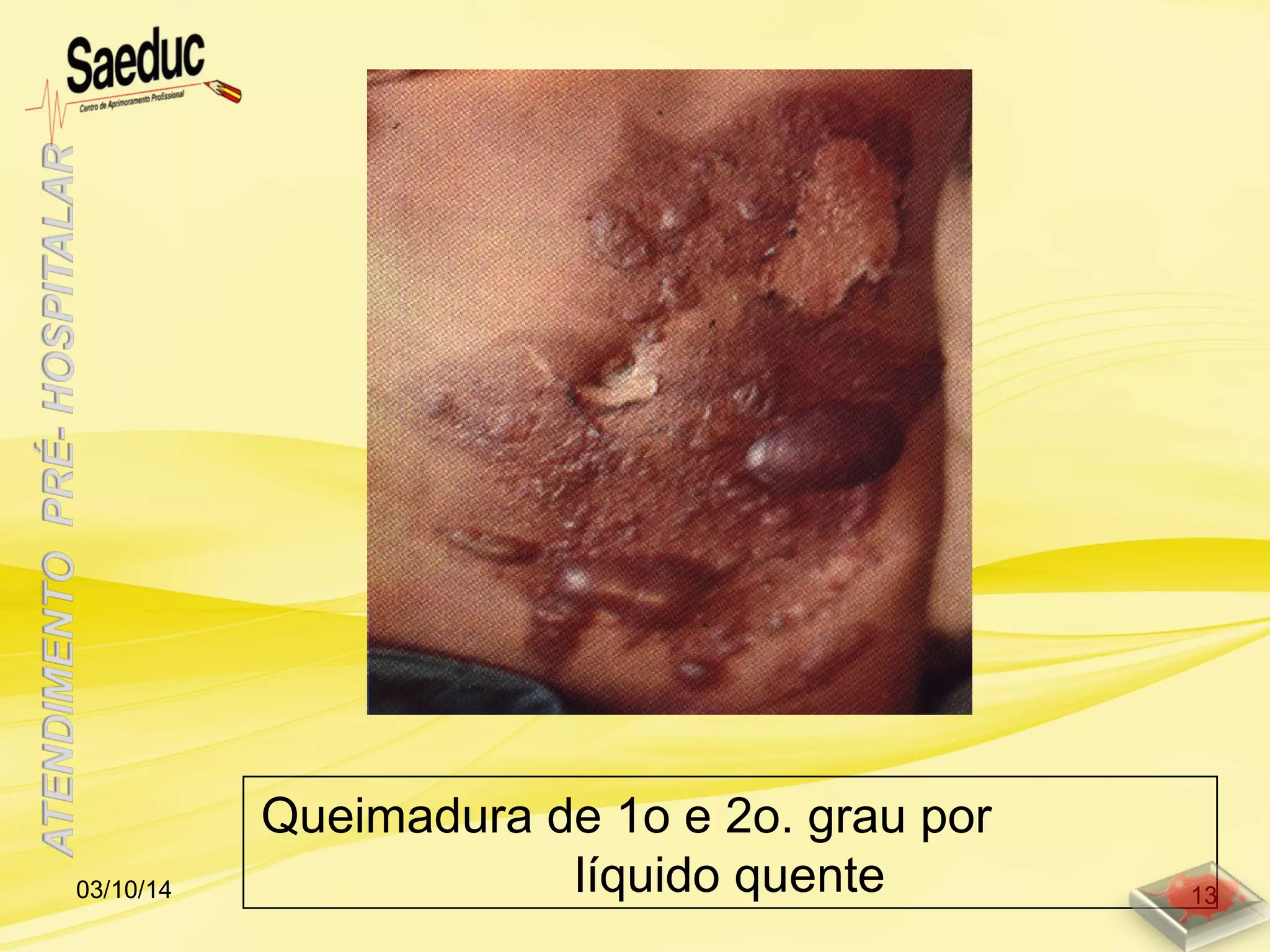 Queimadura de 1o e 2o. grau por
líquido quente03/10/14 13
 
