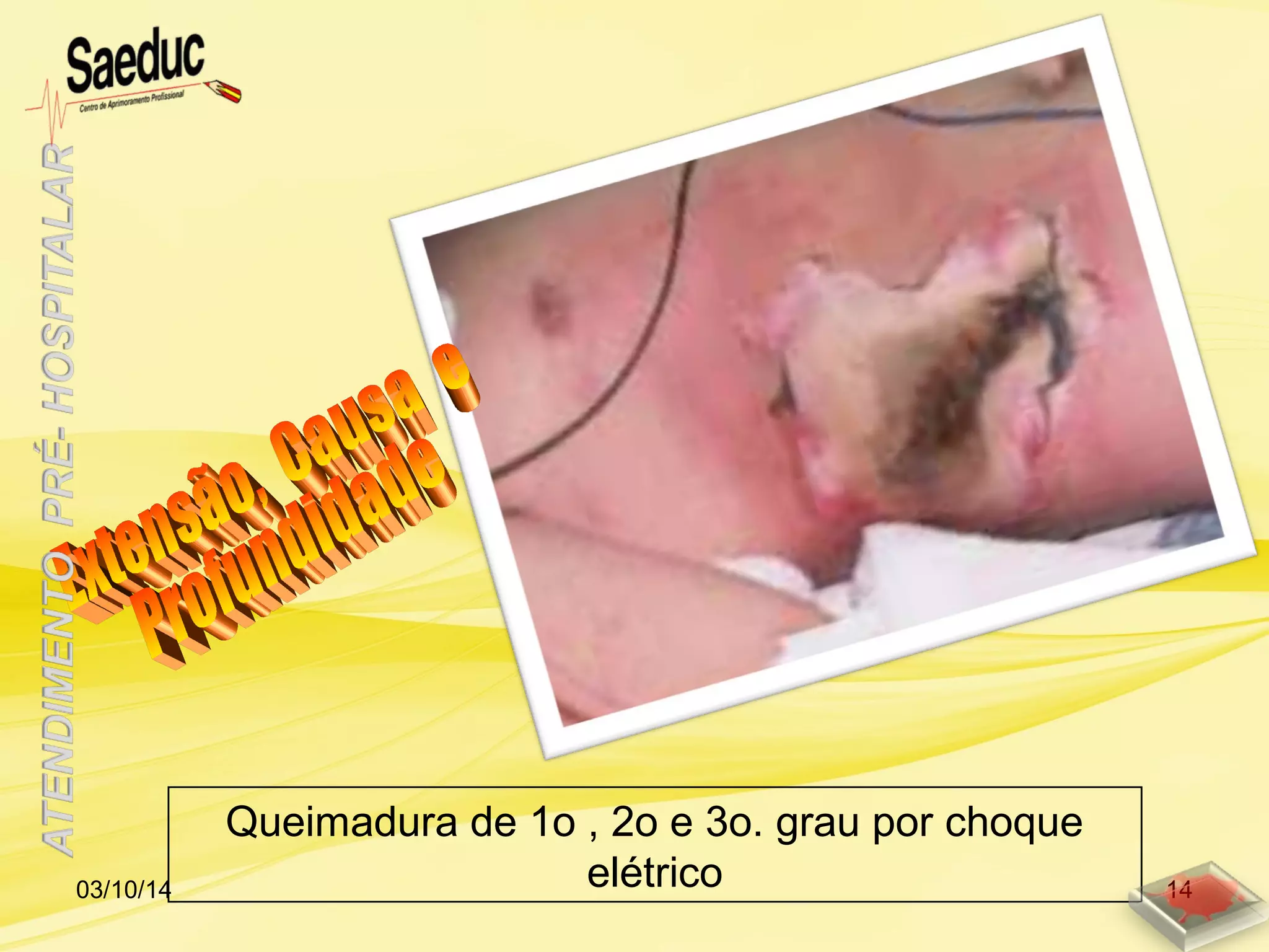 Queimadura de 1o , 2o e 3o. grau por choque
elétrico03/10/14 14
 