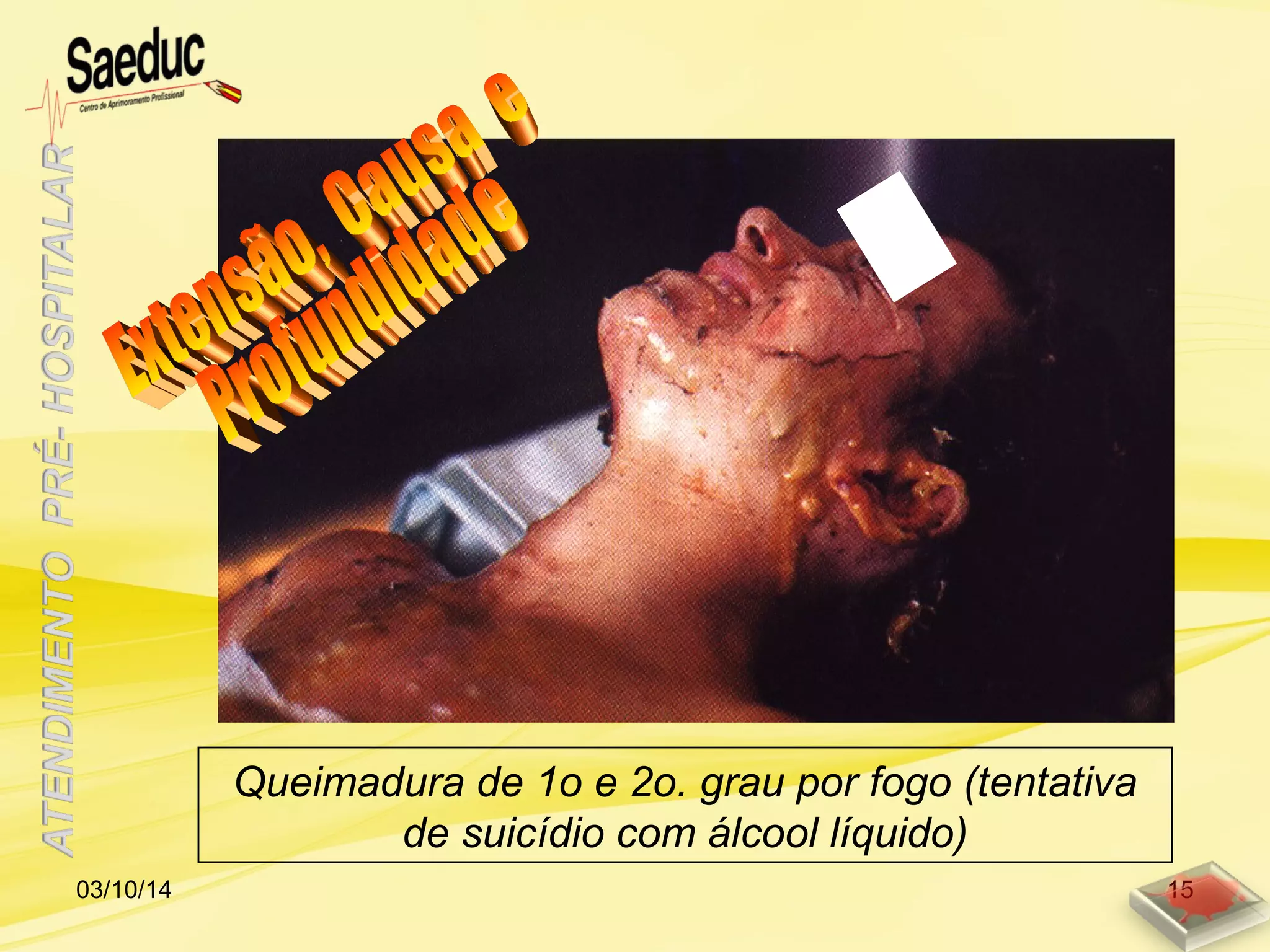 Queimadura de 1o e 2o. grau por fogo (tentativa
de suicídio com álcool líquido)
03/10/14 15
 