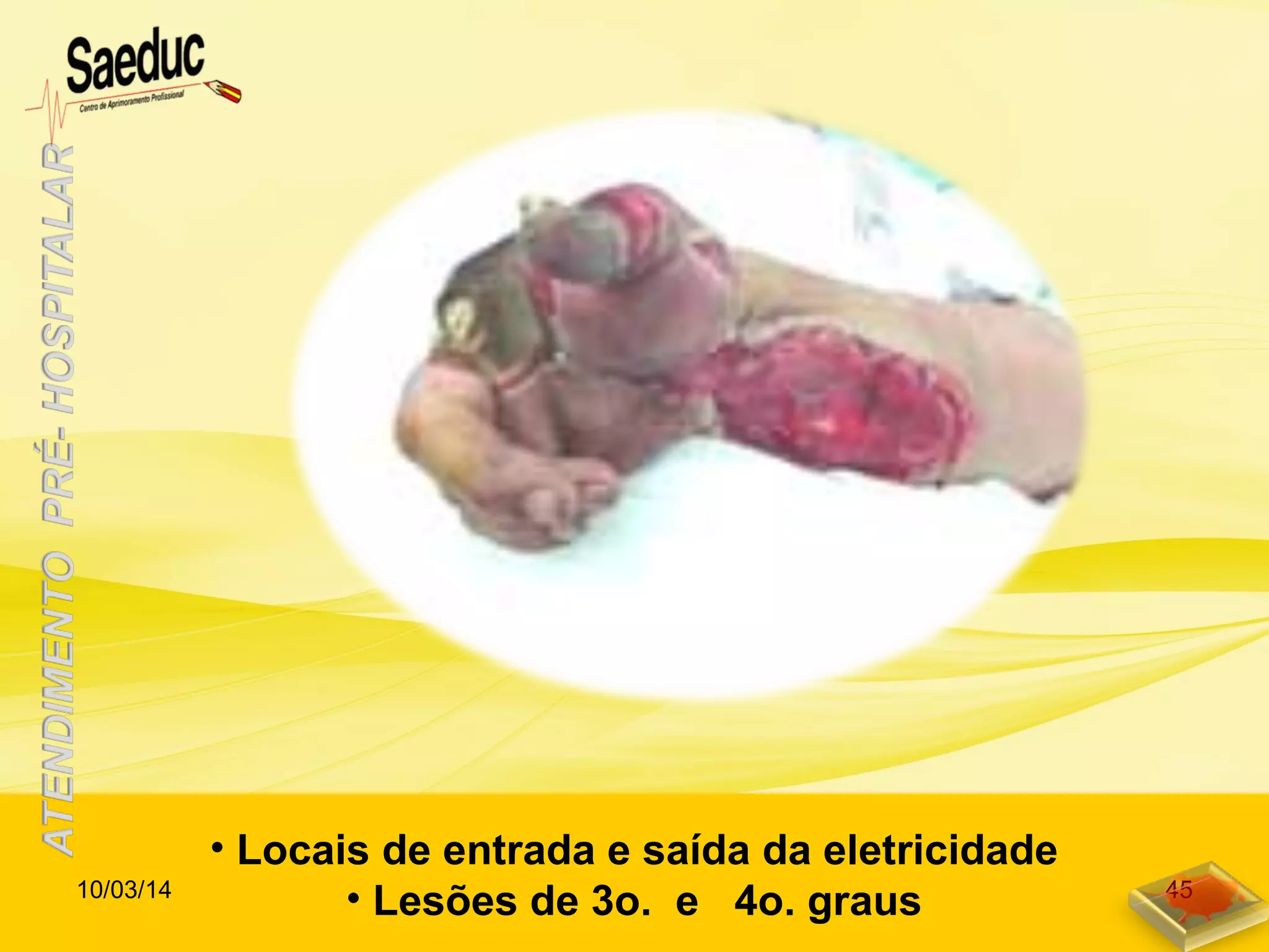• Locais de entrada e saída da eletricidade
• Lesões de 3o. e 4o. graus10/03/14 45
 
