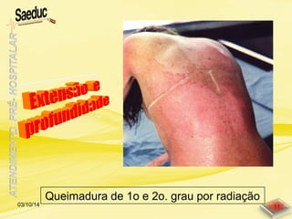 Queimadura de 1o e 2o. grau por radiação
03/10/14 11
 