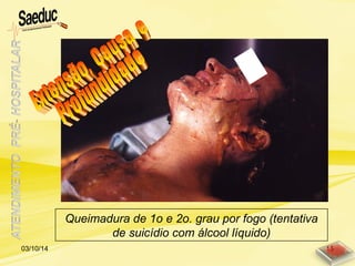 Queimadura de 1o e 2o. grau por fogo (tentativa
de suicídio com álcool líquido)
03/10/14 15
 